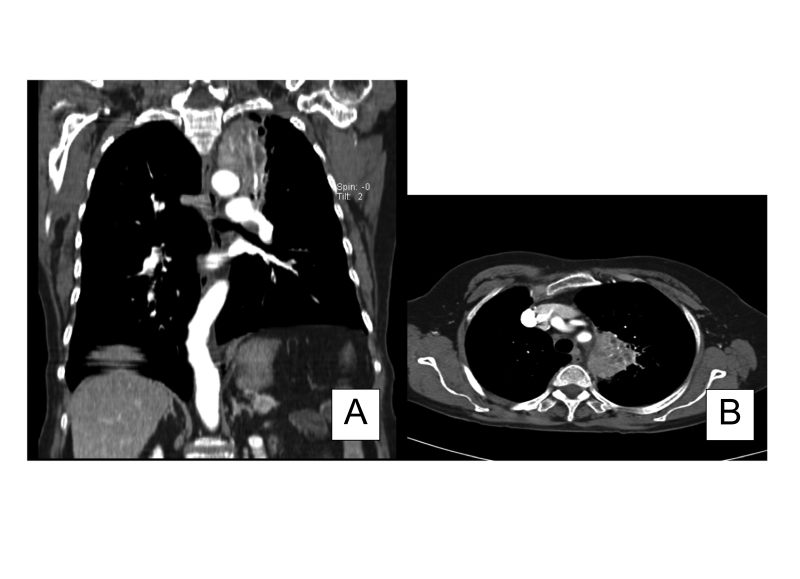 Anthracosis and large mediastinal mass in a patient with healed