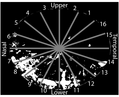 The Differential Effect Of Ultraviolet Light Exposure On Cataract Rate Across Regions Of The