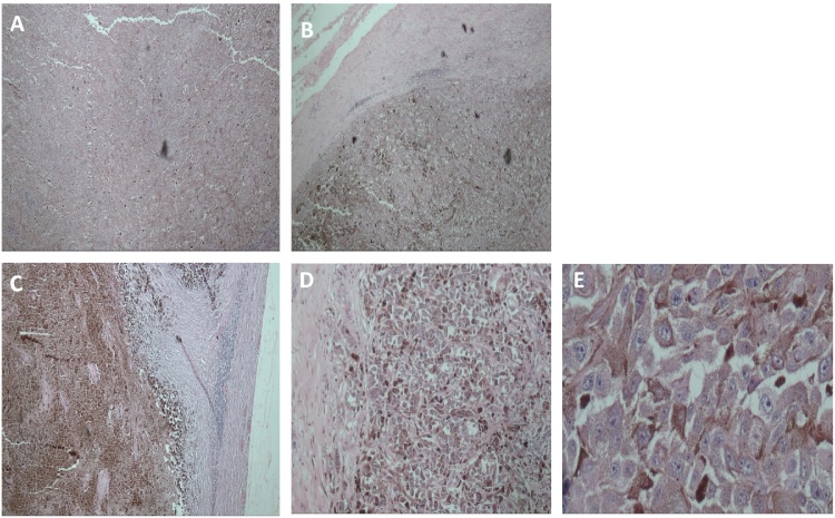 Rare nodular malignant melanoma of the heel in the Caribbean: A case ...