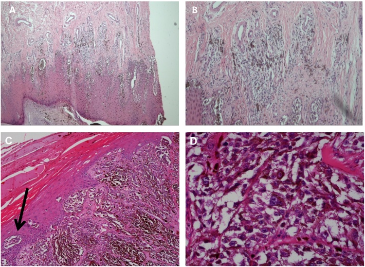 Rare nodular malignant melanoma of the heel in the Caribbean: A case ...