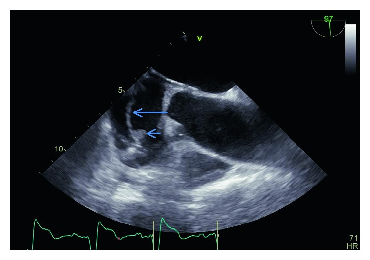A case of pacemaker endocarditis caused by aerococcus urinae pmc