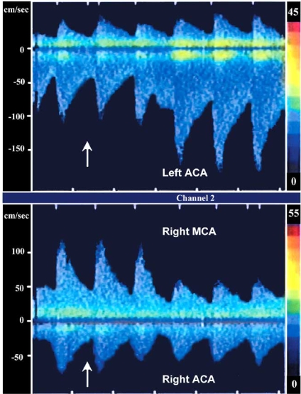 Fig. (3). Recruitment of collateral circulation during carotid artery endarterectomy, Transcranial Doppler study.