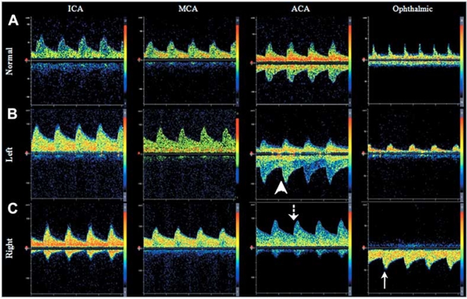 Fig. (4). Transcranial Doppler Ultrasound demonstrating patterns of collateral circulation.