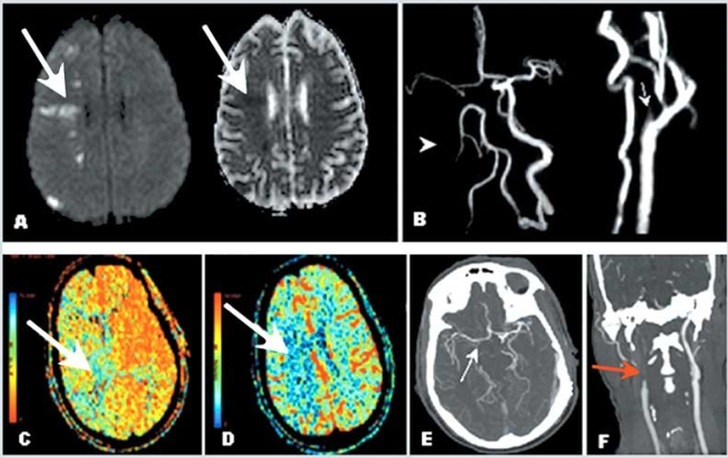 Fig. (7). Example of patient with carotid artery occlusion and clinical fluctuations related to hemodynamic factors; evaluation of collateral circulation and cerebral perfusion.