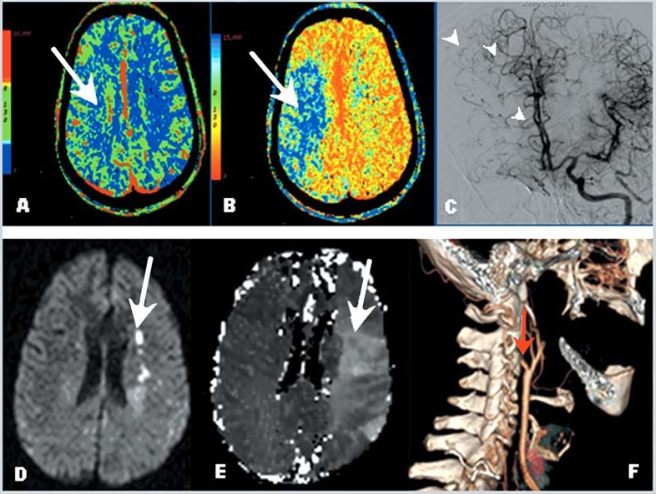 Fig. (5). Cerebral perfusion studies: Computed Tomography and Magnetic Resonance Imaging.