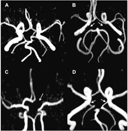 Fig. (2). Common Variants of circle of Willis.