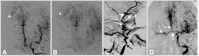 Fig. (6). Cerebral Angiography in a patient with right internal carotid artery occlusion.