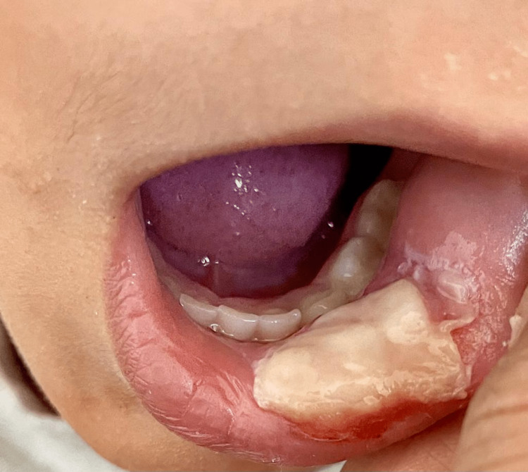 A traumatic ulcer caused by accidental lip biting following topical