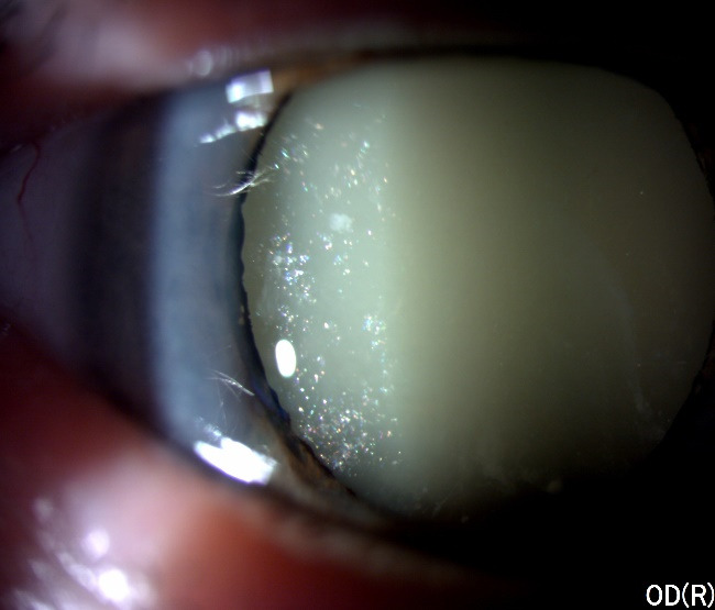 Lens-induced uveitis in a patient with hypermature cataract - PMC