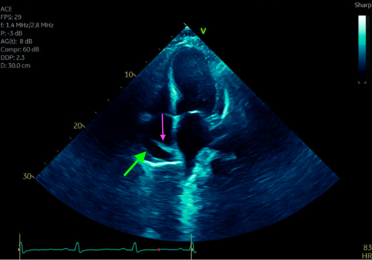 Dressler Syndrome: Not Just a Relic of the Past - PMC