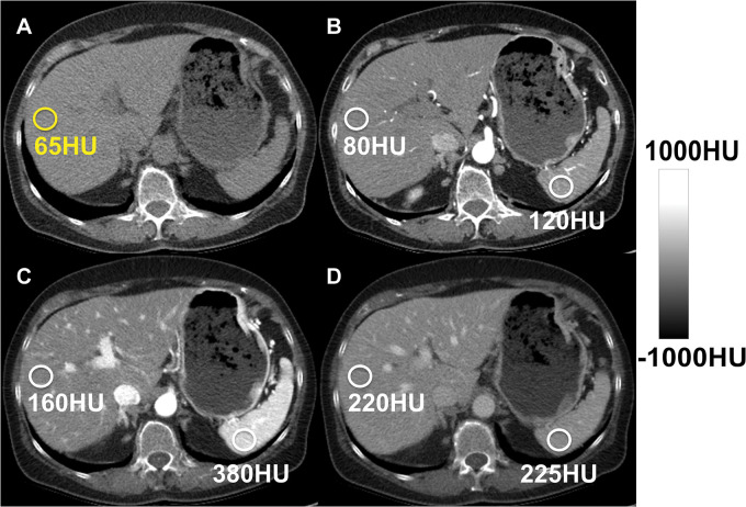 Hepatic steatosis can be quantified using the absolute unenhanced CT attenuation measured in Hounsfield units. Relative liver-spleen Hounsfield unit difference can be used when iodinated contrast material has been administered. An important pitfall to avoid is use of arterial phases where the spleen enhances earlier than the liver, which could be mistaken for hepatic steatosis using the spleen as the reference. CT scans obtained in a patient (A) before and (B–D) after contrast material administration in the arterial (B), late arterial (C), and portal venous (D) phases. No steatosis is seen on unenhanced CT scan (65 HU) (A). CT scans obtained in early (B) and late (C) arterial phase show liver Hounsfield unit is 40 HU and 220 HU less, respectively, than that in the spleen, mimicking steatosis. In portal venous phase (D), attenuation of liver and spleen is essentially equal.