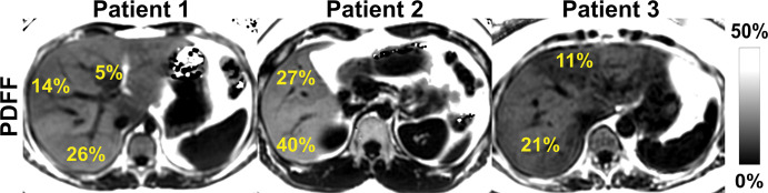 Chemical shift–encoded (CSE) MRI enables assessment of fat content over the entire liver, unlike MR spectroscopy and biopsy, which sample small regions of tissue and provide no information about the spatial variability of steatosis.. Shown are three-dimensional CSE MRI proton density fat fraction (PDFF) maps in three different patients with heterogeneous pattern of steatosis.