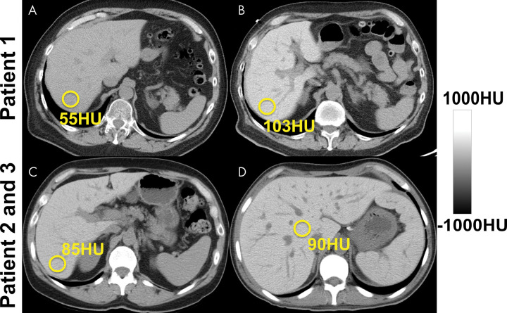 Detection and quantification of liver fat at CT is confounded by substances that increase the attenuation of the liver, such as amiodarone, iron, or glycogen. (A, B) Unenhanced CT images in a patient before (A) and after (B) long-term treatment with amiodarone. (C, D) CT scans obtained in patients with hereditary hemochromatosis (C) and transfusional hemosiderosis (D) show increased liver attenuation.