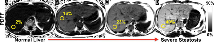 Nonalcoholic fatty liver disease can occur at an early age. Chemical shift–encoded (CSE) MRI allows reliable noninvasive quantification of liver fat content in children. These examples show representative proton density fat fraction (PDFF) maps obtained with CSE MRI within a single breath hold in (A) an 11-year-old boy with normal (<5%) liver fat content, (B) a 12-year-old boy with moderate steatosis, (C) an 11-year-old boy with moderate-to-severe steatosis, and (D) a 27-year-old man with severe steatosis.