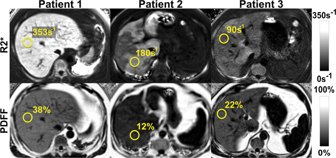 Chemical shift–encoded (CSE) MRI enables simultaneous estimation of both liver fat and iron deposition. Fat-corrected R2* (R2* = 1/T2*) mapping is a natural byproduct of multi-echo CSE acquisitions used for R2*-corrected proton density fat fraction (PDFF) mapping. Shown are representative MRI scans in three patients with various fat and iron levels throughout the liver.