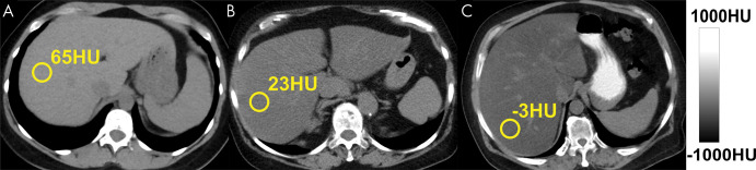 Triglycerides have lower x-ray absorption than normal liver parenchyma, leading to decreased CT attenuation (measured in Hounsfield units) with increasing liver fat content. Shown are three example noncontrast CT images in patients with increasing degrees of fat content. Images were obtained in (A) a patient with normal liver and (B, C) patients with moderate-to-severe (B) and severe (C) hepatic steatosis. The MRI proton density fat fraction equivalent values to 65 HU, 23 HU, and –3 HU are approximately 0.5%, 25%, and 40%, respectively.