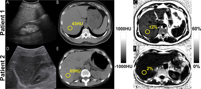 Among the noninvasive modalities used for quantification of liver fat, chemical shift–encoded (CSE) MRI–based proton density fat fraction (PDFF) mapping has the best combination of accuracy, precision, and reproducibility in the measurement of liver fat content. Estimation of hepatic fat content using US is based on increased echogenicity and sound attenuation and has low accuracy for detection of mild-to-moderate steatosis. Decreased x-ray attenuation (Hounsfield units) on noncontrast CT scans can be used to quantify liver fat and correlates closely and linearly with MRI PDFF. CSE MRI generates confounder-corrected volumetric quantitative maps of PDFF, a fundamental property of tissue. (A, D) Conventional US images, (B, E) noncontrast CT images, and (C, F) MRI PDFF maps in 44-year-old man (patient 1) with mild-to-moderate hepatic steatosis (MRI PDFF = 12%, CT attenuation = 43 HU) and 59-year-old woman (patient 2) without steatosis (MRI PDFF = 2%, CT attenuation = 65 HU).