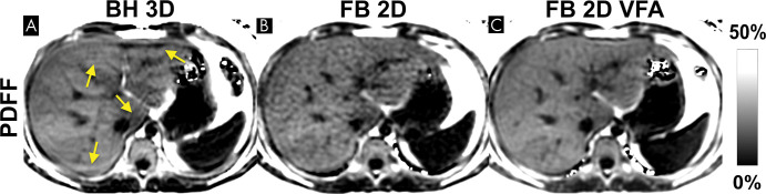 Free-breathing (FB) two-dimensional (2D) sequential chemical shift–encoded (CSE) MRI with centric encoding and variable flip angle (VFA) strategy is a promising technique that can mitigate respiratory motion while achieving high signal-to-noise ratio (SNR). Example proton density fat fraction (PDFF) maps using breath holding (BH) and free breathing are shown. (A) Three-dimensional (3D) multi-echo spoiled gradient-echo CSE MRI provides good SNR performance, but reliable breath holding is necessary to avoid motion-related artifacts that can occur even during breath holding (arrows). (B) Free-breathing two-dimensional CSE MRI freezes respiratory motion by using a very short temporal window, at the expense of lower SNR due to the use of low flip angles needed to avoid T1-related bias. (C) In contrast, a recently proposed variable flip angle sequential approach shows promise to avoid breathing artifacts and T1 bias while achieving high SNR performance (101).