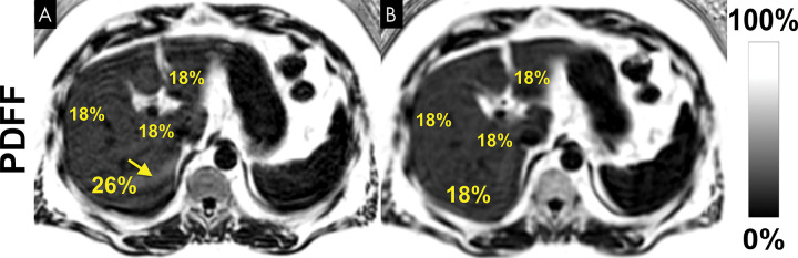 Motion-related ghosting from adipose tissue into the liver can lead to substantial bias and variability of proton density fat fraction (PDFF) measurements. Although three-dimensional chemical shift–encoded (CSE) MRI acquisitions are relatively short (approximately 15–20 seconds), many patients are unable to hold their breath even for this modest acquisition time. PDFF maps acquired using three-dimensional CSE MRI in the same patient during (A) free-breathing and (B) breath-hold. Scan obtained during free breathing shows artifactually increased PDFF value due to ghosting artifact from adipose tissue (arrow in A)..