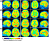 Four rows of brain SPECT images labeled (A) to (D) show axial, coronal, and sagittal views of cerebral perfusion with a color scale indicating normalized counts per voxel from 0 (black) to 60 (red). Red arrows highlight regions of hypoperfusion, particularly in panels (A), (B), and (D), most notably in the parietal and occipital lobes. Panel (C) shows relatively preserved perfusion without marked abnormalities. The anterior-posterior orientation is marked in (A), and lateralization is indicated as right (R) and left (L). The images compare perfusion patterns across different conditions or timepoints.