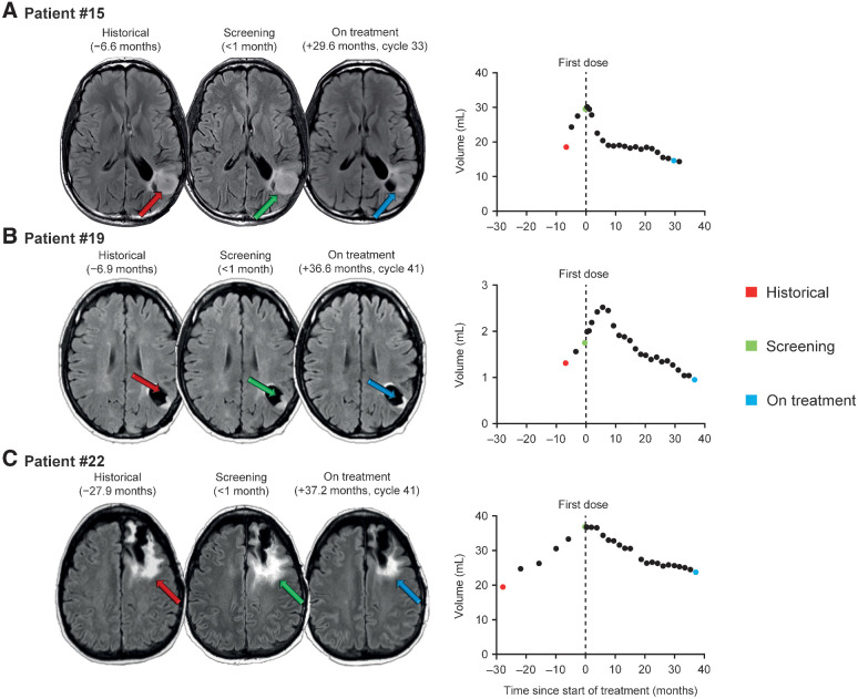 Figure 2. Brain MRI and volume growth curves in 3 patients with nonenhancing glioma treated with vorasidenib. Visual inspection of the images, as well as tumor size and volume measurements, showed tumor shrinkage after vorasidenib treatment. A, Patient #15 is a 47-year-old male with an anaplastic astrocytoma that was initially treated with surgery, radiotherapy, and procarbazine/CCNU/vincristine. Best response as of data cutoff: stable disease. B, Patient #19 is a 40-year-old female with an oligoastrocytoma that was initially treated with surgery and temozolomide. Best response as of data cutoff: mR. C, Patient #22 is a 49-year-old female with an oligodendroglioma that was initially treated with surgery and no other treatment. Best response as of data cutoff: PR. Scan collection time points relative to first dose and corresponding on-treatment cycle numbers are shown.