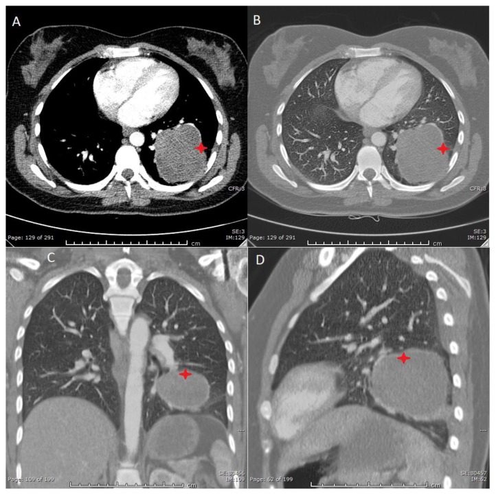 The Radiologic and Pathologic Diagnosis of Biphasic Pulmonary Blastoma ...