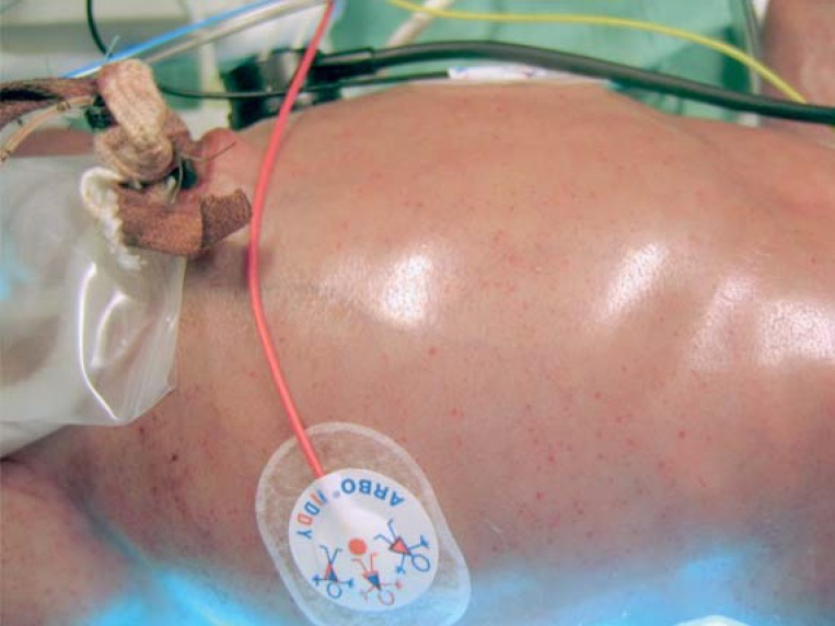 Figure: Petechiae in a newborn with congenital human cytomegalovirus infection requiring intensive care.