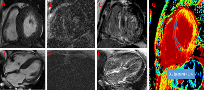 Cardiac magnetic resonance imaging (CMR) of a patient presenting with dyspnea and found to have left ventricular hypertrophy