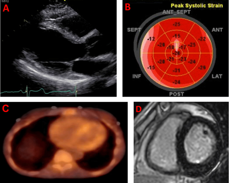 Multimodality imaging in the workup of a 70-year-old patient who is a carrier for the p.V50M variant and who presented with exertional shortness of breath and palpitations