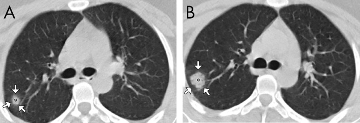 Nonenhanced axial chest CT images in a 27-year-old woman. A, Image shows a solid nodule (*) surrounded by a ground-glass halo in the posterior right upper lobe segment (arrows). B, Image at the same level as in A, obtained 4 days after, shows increase in size of the solid nodule (*), with development of small peripheral air bronchograms.