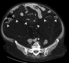 CT shows symmetrical and homogeneous increased retroperitoneal fat