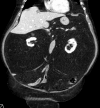Coronal image demonstrates symmetrical and homogeneous increased retroperitoneal fat