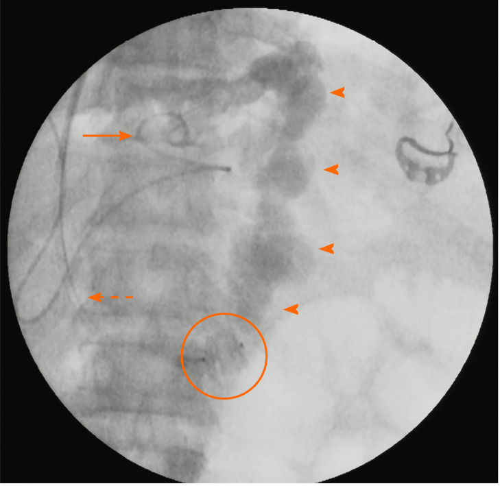 Transjugular intrahepatic portosystemic shunt in cirrhosis: An ...