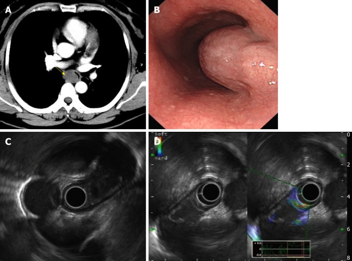 Esophageal Bronchogenic Cyst Excised By Endoscopic Submucosal Tunnel 