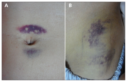 Cullen and Grey Turner signs in idiopathic perirenal hemorrhage - PMC