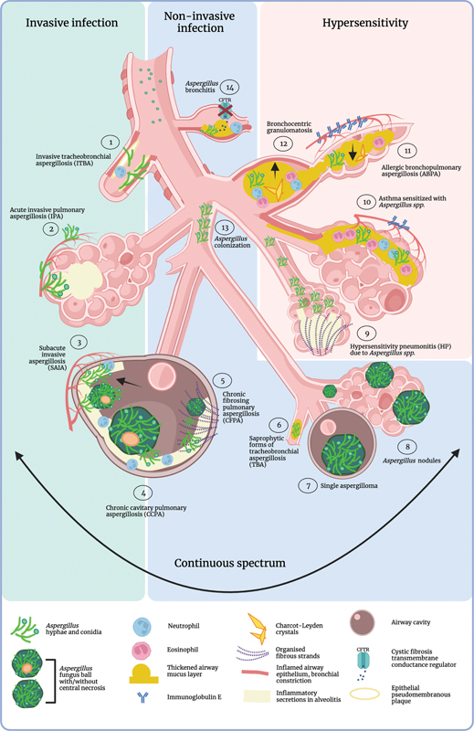 Aspergillus and the Lung - PMC