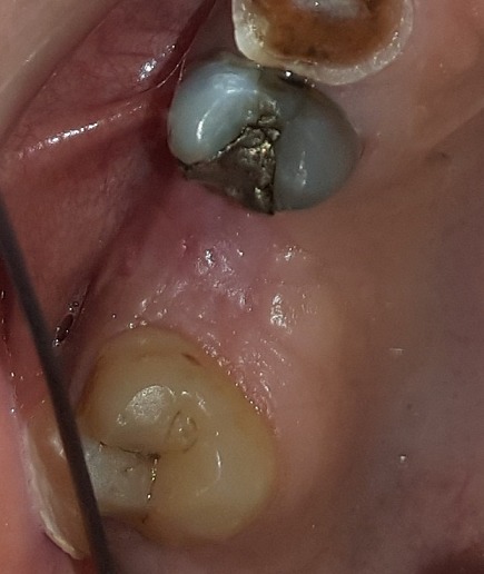 Management of oroantral communication using buccal advanced flap - PMC