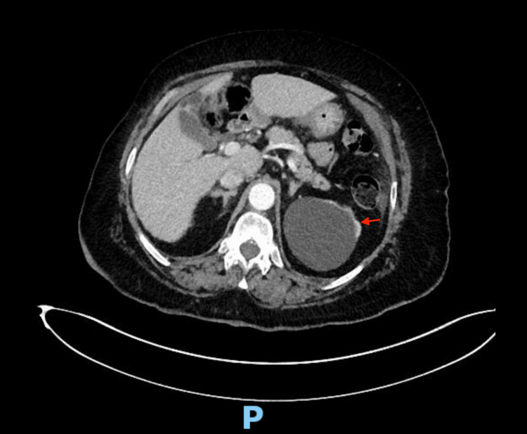 Hemolytic anemia secondary to rasburicase treatment in the setting of