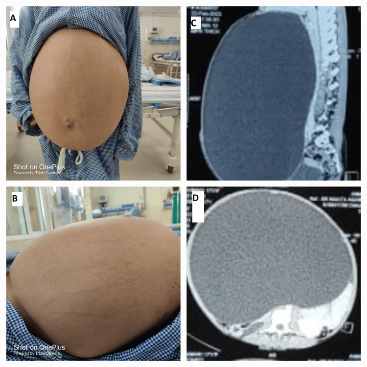 Complete Laparoscopic Ovarian Cystectomy Of Giant Ovarian Serous complete-laparoscopic-ovarian-cystectomy-of-giant-ovarian-serous