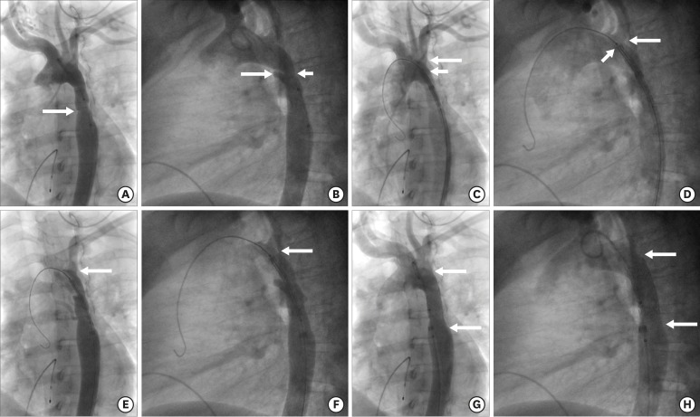 Management of Coarctation of The Aorta in Adult Patients: State of The ...