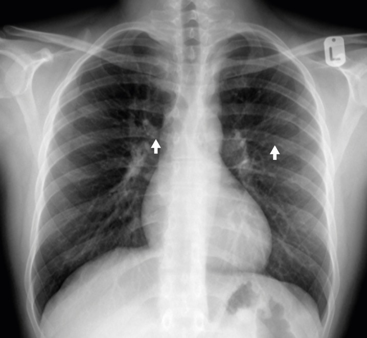 Management of Coarctation of The Aorta in Adult Patients: State of The ...