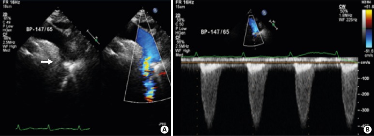 Management of Coarctation of The Aorta in Adult Patients: State of The ...