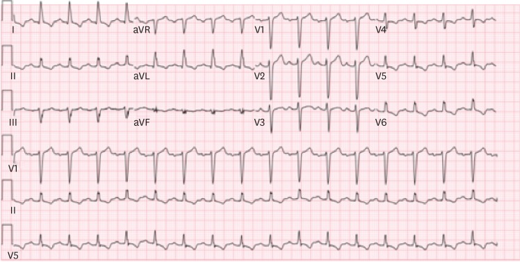 Management of Coarctation of The Aorta in Adult Patients: State of The ...