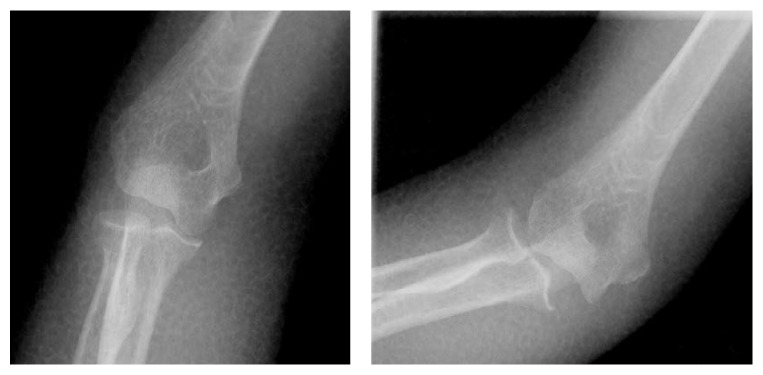 Successful Closed Reduction Of A Lateral Elbow Dislocation - Pmc