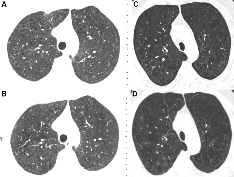 Inspiratory axial noncontrast CT scans obtained at baseline and 5-year-follow-up in two participants demonstrate emphysema progression according to the deep learning automated method. (A) Baseline scan shows mild emphysema in a 49-year-old man. (B) Image obtained at 5-year follow-up shows progression to moderate emphysema. Forced expiratory volume in 1 second (FEV1) decreased by 677 mL. (C) Baseline scan shows moderate emphysema in a 62-year-old man. (D) Image obtained at 5-year follow-up shows progression to confluent emphysema. FEV1 decreased by 502 mL.