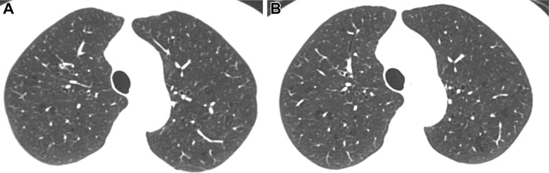 Inspiratory axial noncontrast CT scans obtained at (A) baseline and (B) 5-year follow-up in a 73-year-old woman. There was no change in emphysema grade according to the deep learning automated method. Both baseline and 5-year follow-up scans show mild emphysema. Forced expiratory volume in 1 second did not change at follow-up.