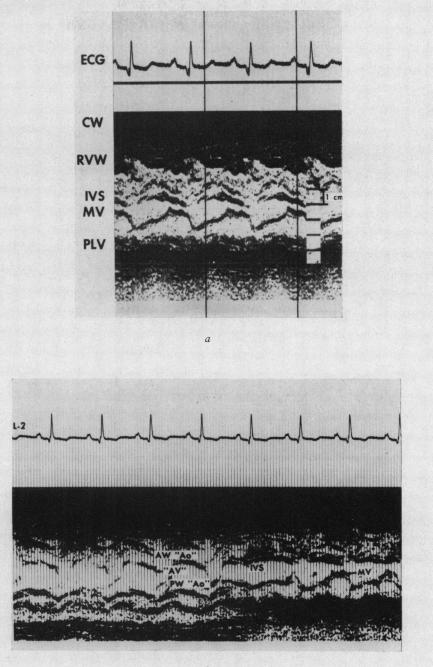 graphic file with name brheartj00269-0114-a.jpg