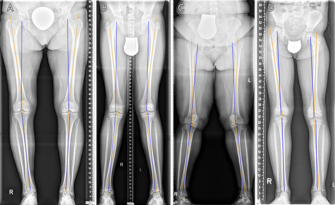 Algorithm-based quantitative analysis of lower-extremity alignment in representative patients reflective of the spectrum of clinical indications. A, Female adult patient with bilateral medial compartmental osteoarthritis of the knee joints. B, Male adolescent patient with bilateral valgus deformity. C, Female adult patient with valgus deformity and morbid obesity. D, Female child with dysplasia of the right hip, pelvic obliquity, and leg-length discrepancy. Although the algorithm-based identification of the mechanical (blue) and anatomic axes (orange) was robust and not affected by joint degeneration, A, incomplete bone maturation, B, D, eccentric projection of both patellae, B, C, excess skin folds, C, displaced gonad shields, C, or open epiphysial plates, D, segmentation outlines were rendered focally imprecise. Corresponding original radiographs and segmentation outlines are detailed in Figure E2 (supplement). Units of scales, if present, are centimeters.