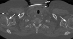 ON of the humeral heads in a 62-year-old woman with a history of
sickle cell disease and post–COVID-19 condition with progressive
shortness of breath and corticosteroid treatment. Axial CT image (bone
window) of the chest shows subchondral serpentine lucency, adjacent
sclerosis (arrows), and subchondral plate irregularity involving both
humeral heads, especially on the left. The humeral heads appeared normal at
a prior CT examination 1.5 years earlier (see supplemental online
presentation).