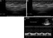 Diaphragm atrophy and poor contractility in a 46-year-old man with
COVID-19 with persistent dyspnea, right hemidiaphragm dysfunction, and
normal left hemidiaphragm function. (A) Gray-scale US image of the right
hemidiaphragm in the ninth intercostal space during the expiratory phase of
respiration shows that the zone of apposition of the diaphragm measures 0.18
cm. The left hemidiaphragm thickness was 0.24 cm (see supplemental online
presentation), and normal thickness is approximately 0.15 cm or greater. (B)
Gray-scale US image of the same region during the inspiratory phase of
respiration shows that the zone of apposition of the diaphragm measures 0.20
cm. The left hemidiaphragm thickness was 0.33 cm (see supplemental online
presentation), and normal thickness is about 0.18 cm or greater. The
contractility ratio, which is the thickness of the zone apposition with
inspiration divided by the thickness during expiration, measures 1.1, and
normal is at least 1.2. (C) M-mode US image of the diaphragm over several
deep breaths shows that the diaphragmatic excursion, which is the height of
the diaphragm with terminal expiration minus the height of the diaphragm
during deep inspiration, measures 1.46 cm. Although the absolute thickness
of the diaphragmatic zone of apposition on the right is normal with
inspiration and expiration, there is a significant difference between the
right and left sides, and the contractility ratio is lower than expected.
Furthermore, the diaphragmatic excursion with deep breathing is much less
than expected. Together, these findings are consistent with left
hemidiaphragm atrophy and dysfunction.